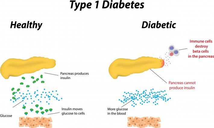 Diabetes type 1