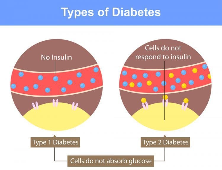 Types of diabetes