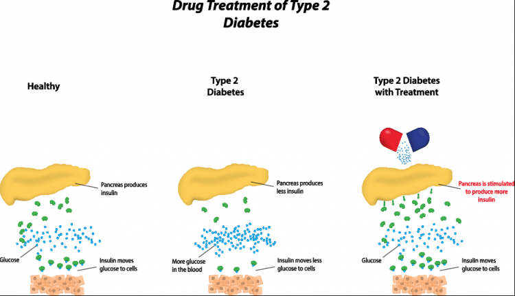 Drug treatment for Diabetes Type 2