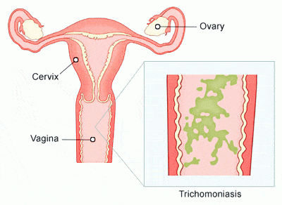 Yeast Infection