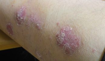 Psoriasis vs Eczema difference