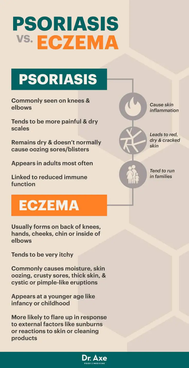 Psoriasis vs Eczema infographic