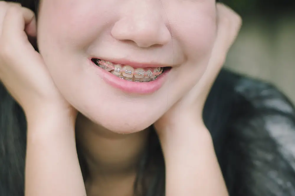 What Are Dental Braces