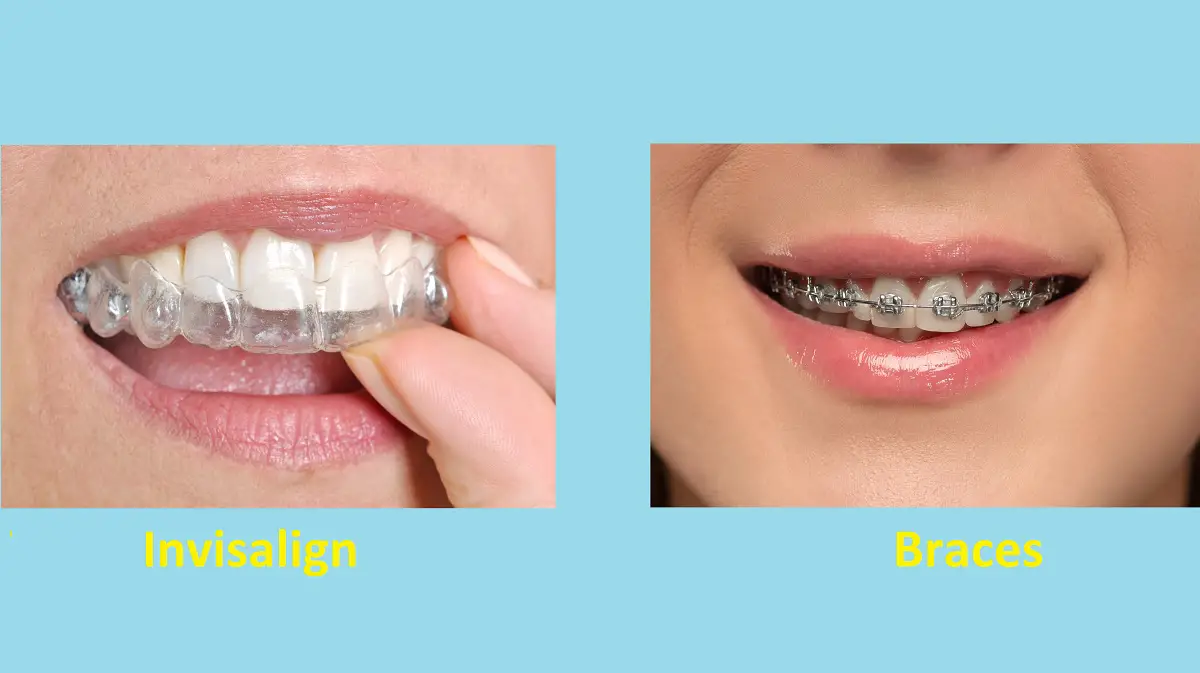 Difference Between Invisalign and Braces (With Comparison Table)