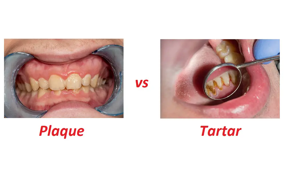 Plaque Vs. Tartar: 3 Key Differences