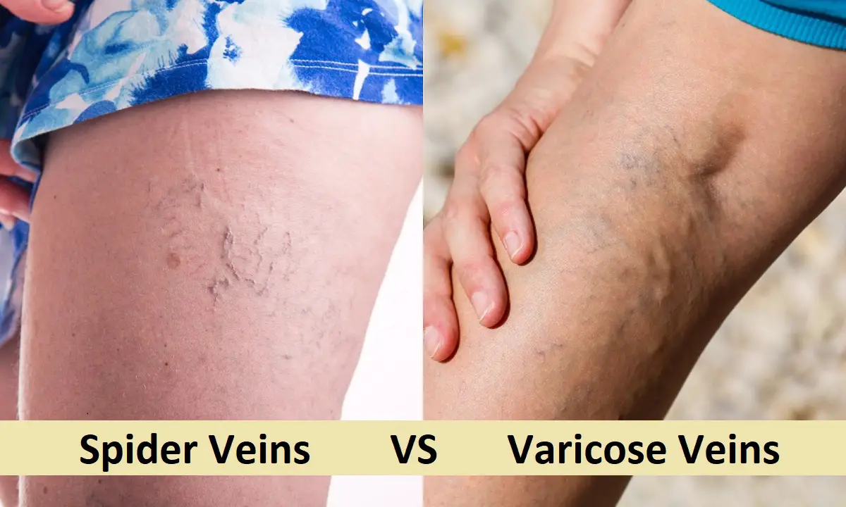 Difference Between Spider Veins And Varicose Veins Difference Camp