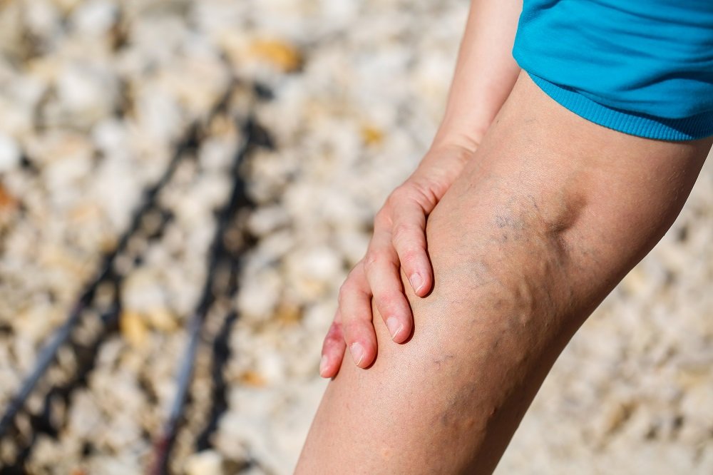 Varicose Veins