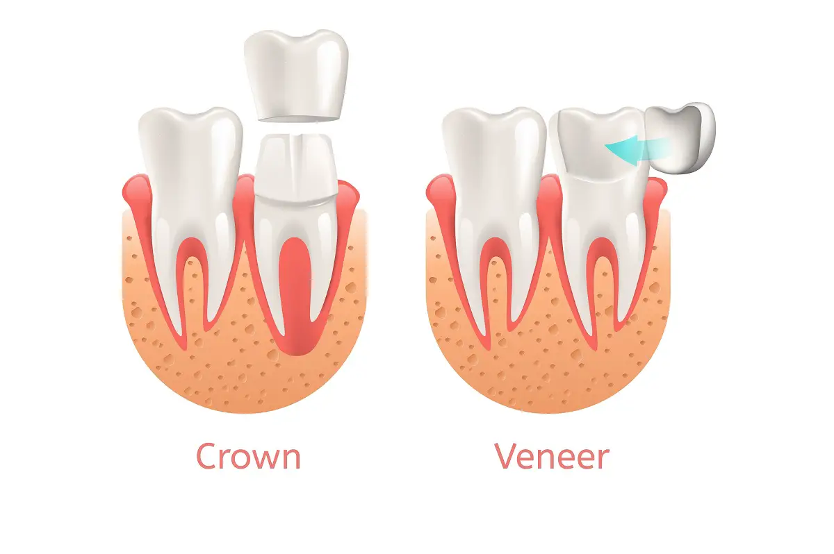 Difference Between Dental Crown and Dental Veneer