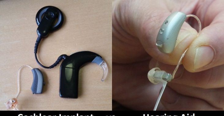 Cochlear Implant vs Hearing Aid