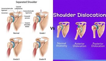 Shoulder Separation vs Shoulder Dislocation