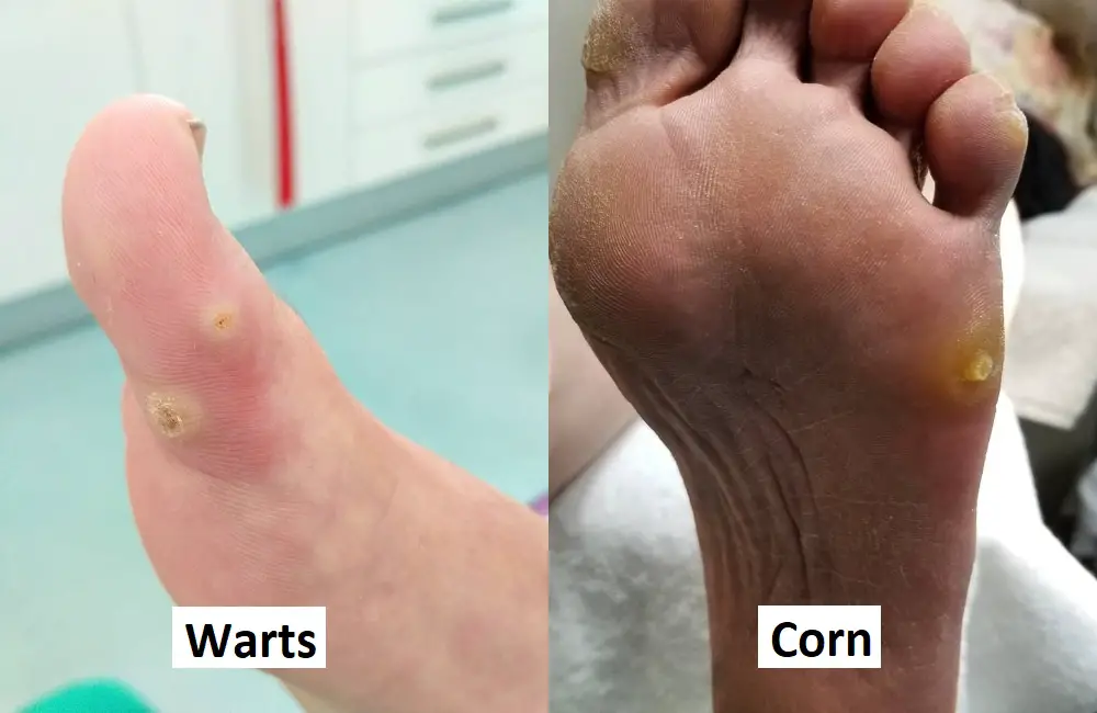 Difference Between Corn and Wart
