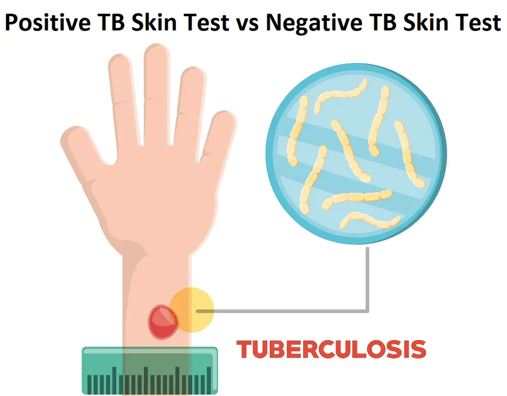 Difference Between Positive TB Skin Test and Negative TB Skin Test