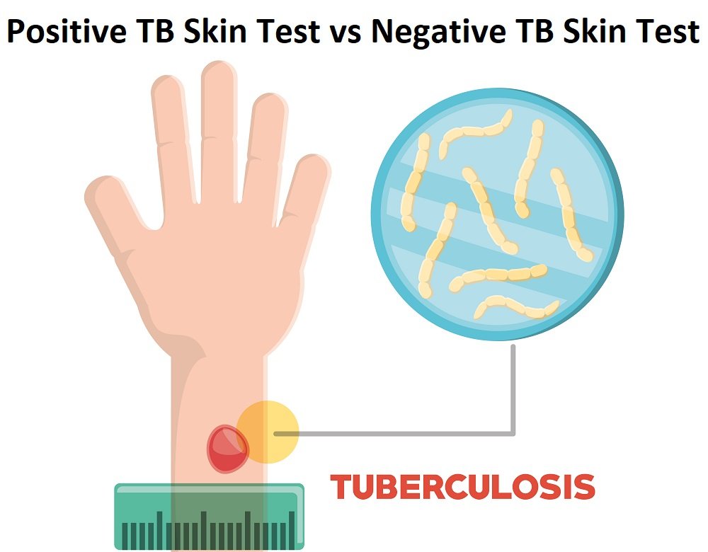 difference between positive TB skin test and negative TB skin test